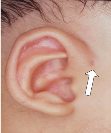耳前竇或耳前瘻管