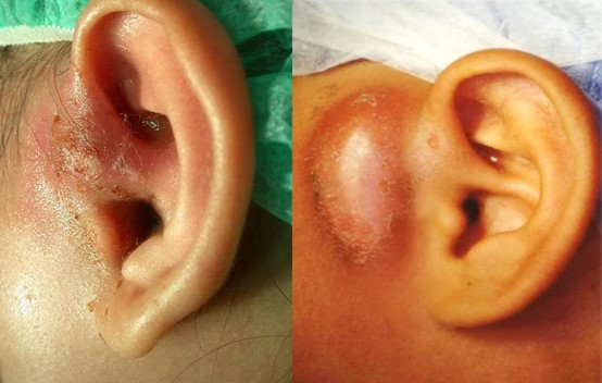 耳前竇或耳前瘻管發炎膿瘍